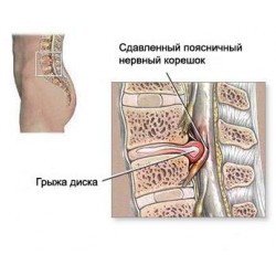 Грыжа межпозвоночного диска Грыжа межпозвоночного диска
